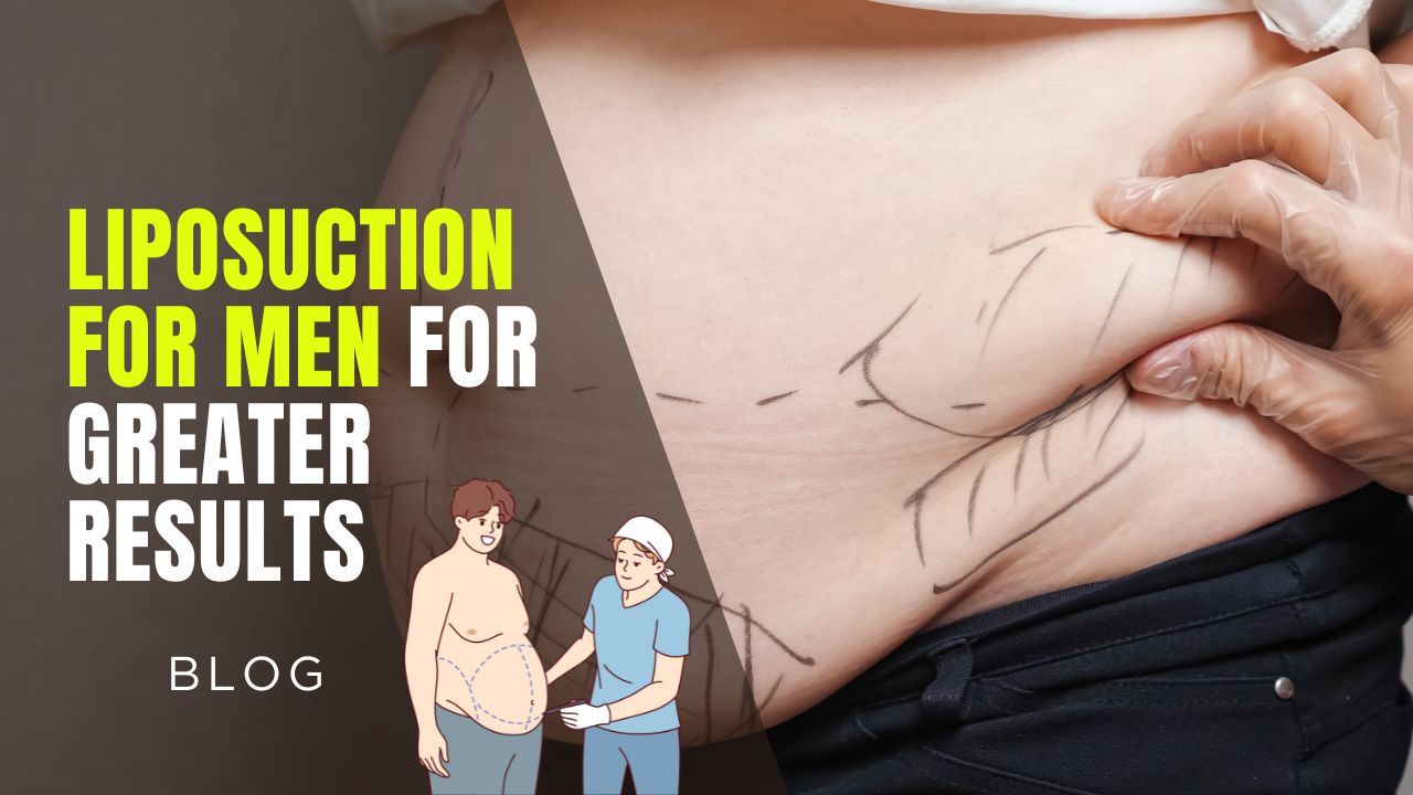 Liposuction for Men: Is It Right for You?