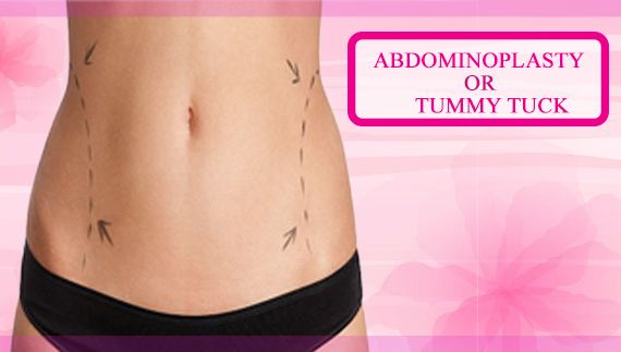Abdominoplasty or Tummy Tuck, Cosmo Arts Clinic
